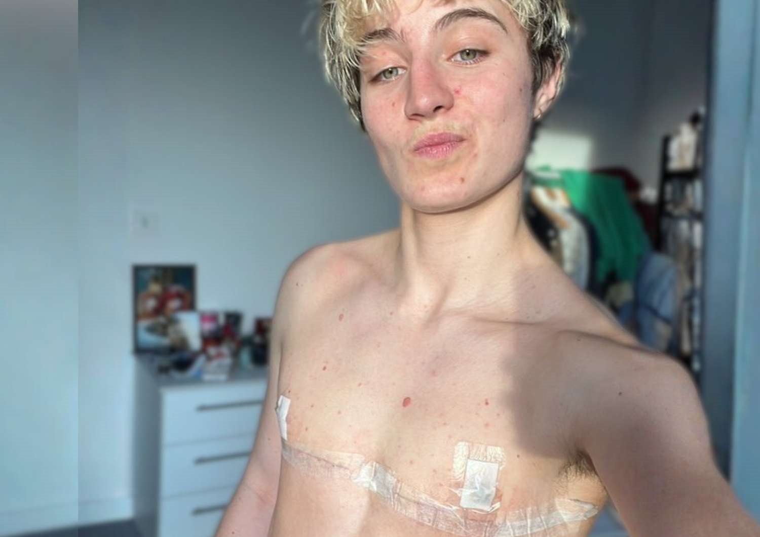 Top surgery patient selfie, Harvey Top surgery patient selfie, Harvey